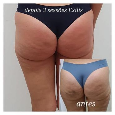 EXILIS ULTRA 360 – Resultados Garantidos