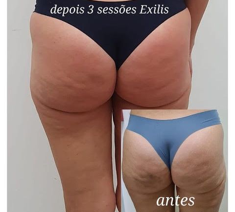 EXILIS ULTRA 360 – Resultados Garantidos